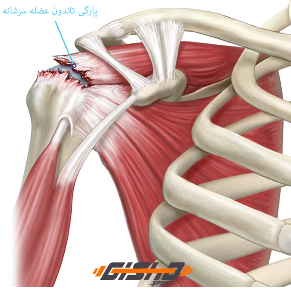 آسیب عضله سرشانه در اثر انجام حرکت های منسوخ شده بدنسازی