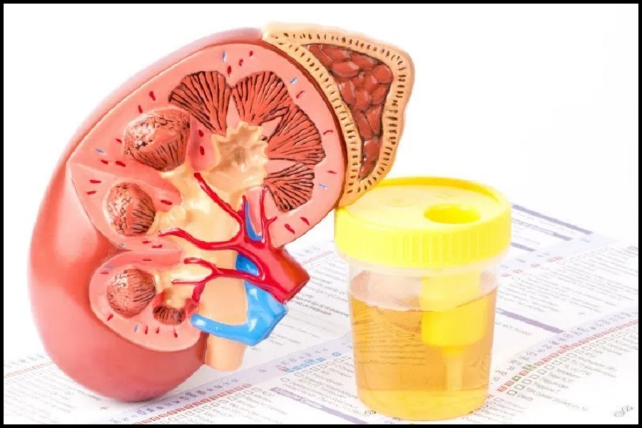 دفع پروتئین در ادرار نشانه چیست؟ + درمان